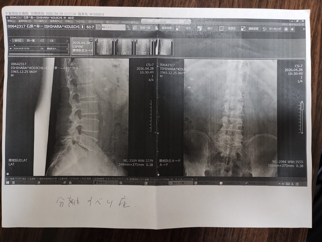 60歳男性の脊髄のレントゲン写真です。診断名は「分離すべり症」です。