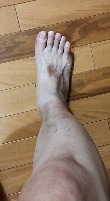 時折足の親指付近が痛みを生じる(激痛)シニア男性の膝下の画像です。